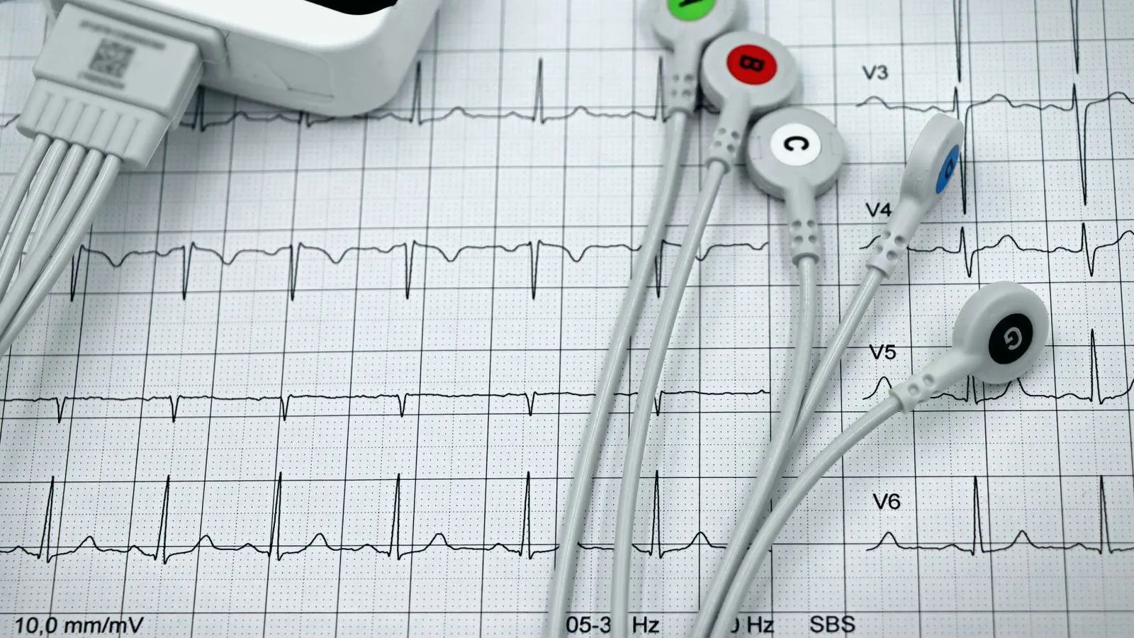 Electrode leads and clips laid across a printed heart rhythm trace