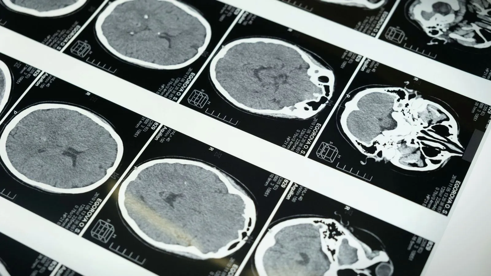 Black-and-white brain scan images arranged on a lightbox